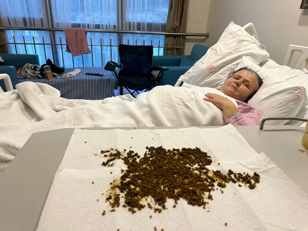 Soma’da 70 Yaşındaki Hastanın Safra Kesesinden 20 Bin Taş Çıktı